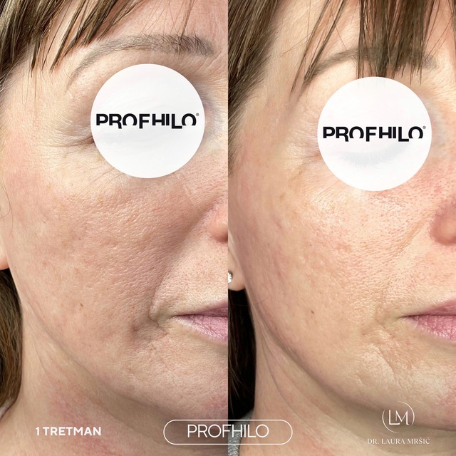 Slika: PROFHILO lice