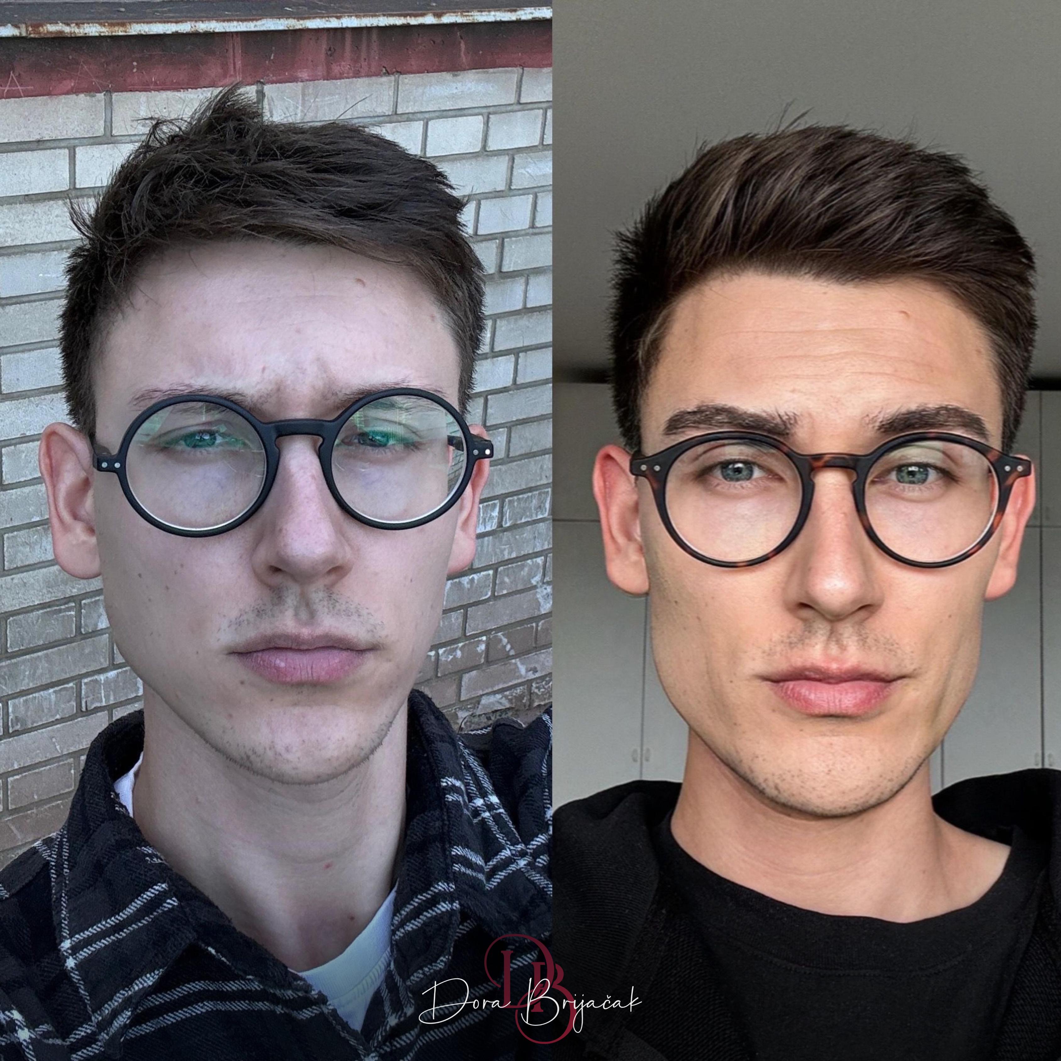 Slika: Radiesse uz dermalni filer