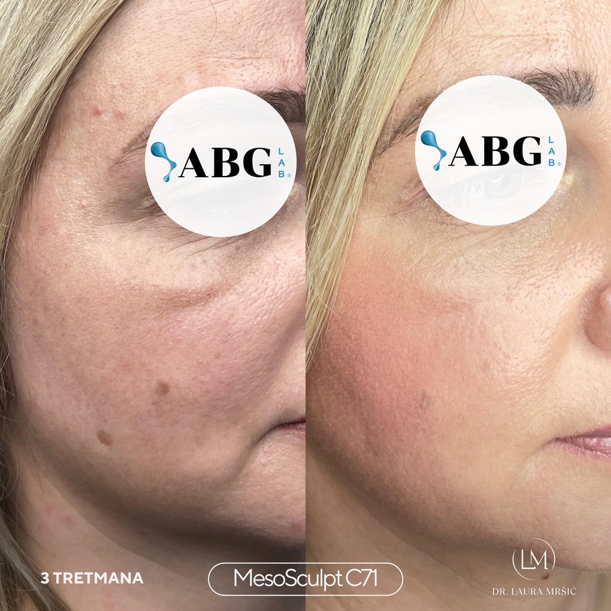 MesoSculpt – malarna regija (3 tretmana)