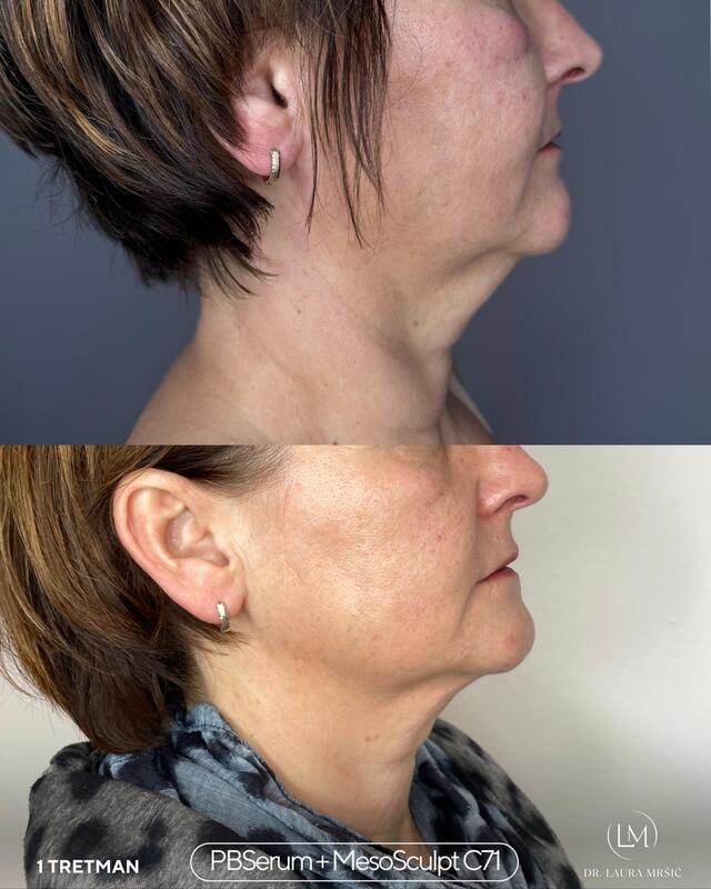 MesoSculpt C71 – konture lica, podbradak (1 tretman + PBserum 1 tretman)