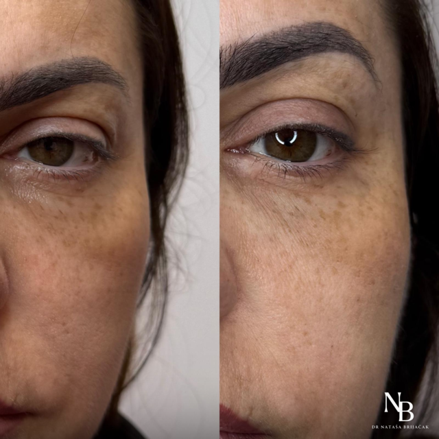 MesoSculpt – malarna regija (3 tretmana)