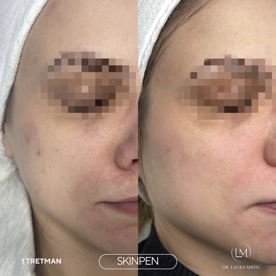 SkinPen mikroneedling