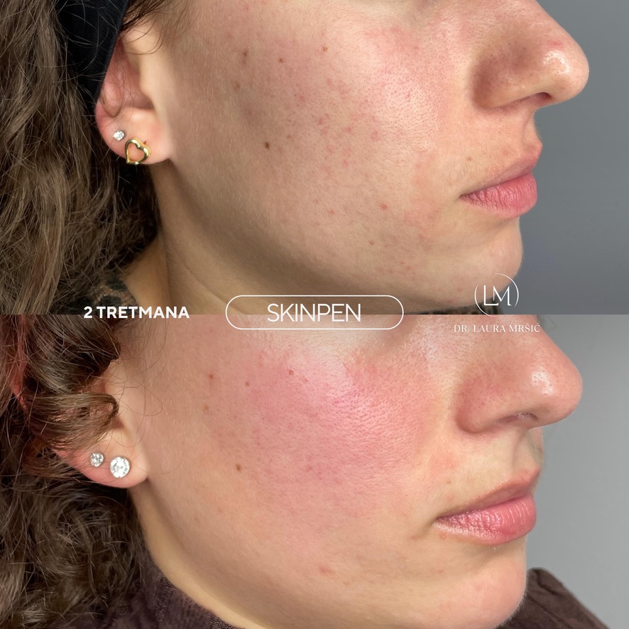 SkinPen mikroneedling