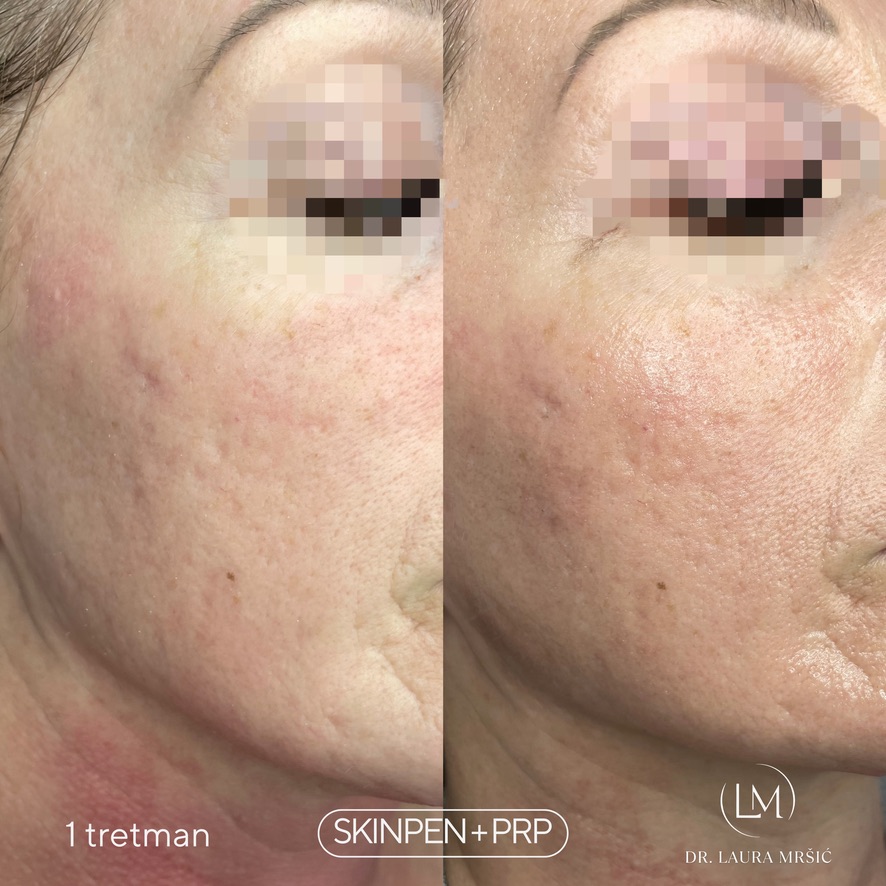 SkinPen mikroneedling