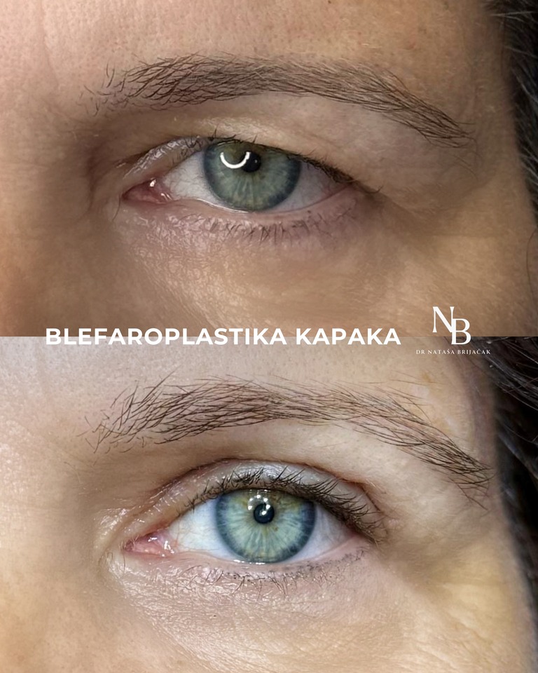 Operacija gornje blefaroplastike