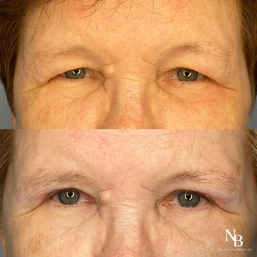 Operacija gornje blefaroplastike